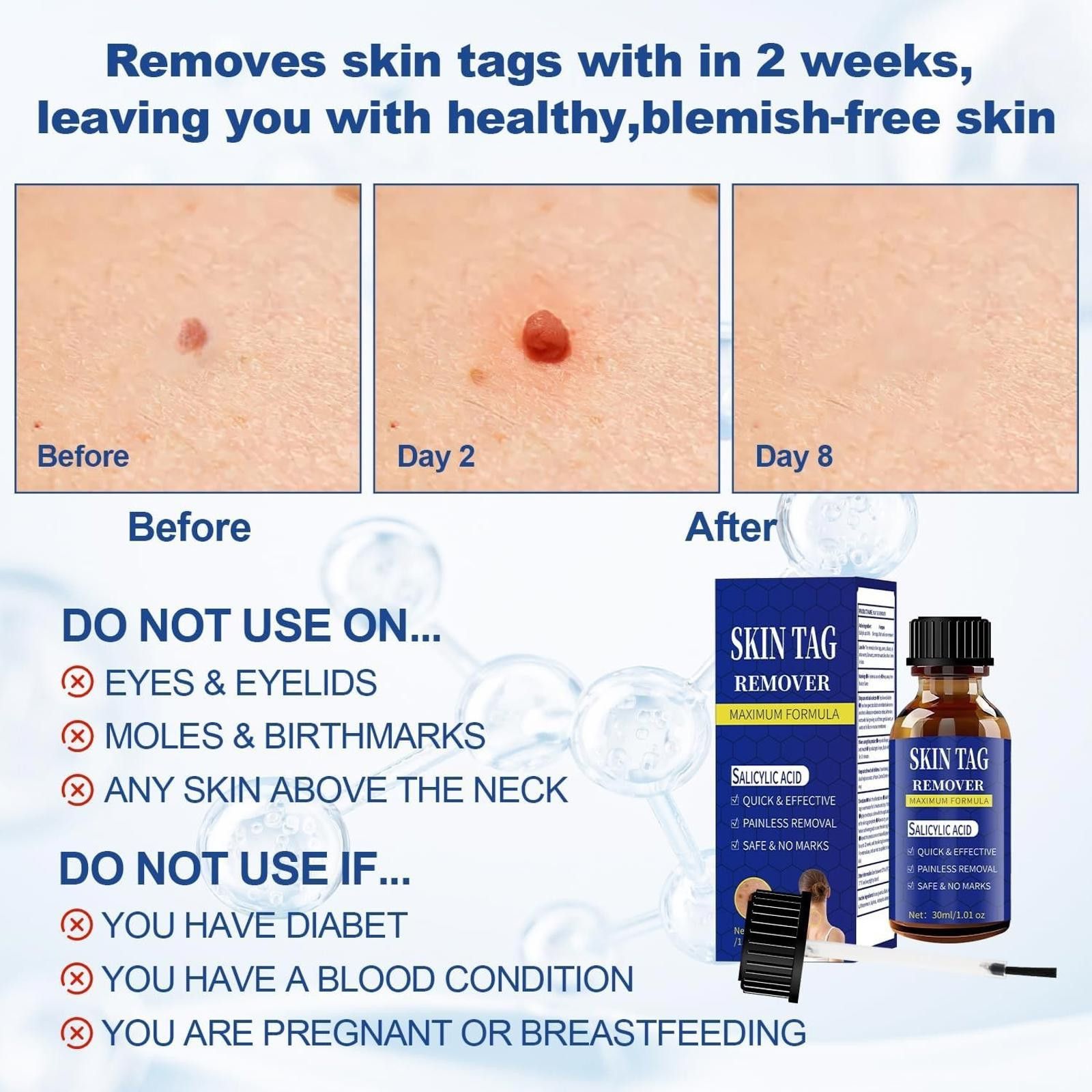 Other Fast-Acting Skin Tag Remover, Maximum Formula 30ml Size ONE SIZE - 6 Thumbnail