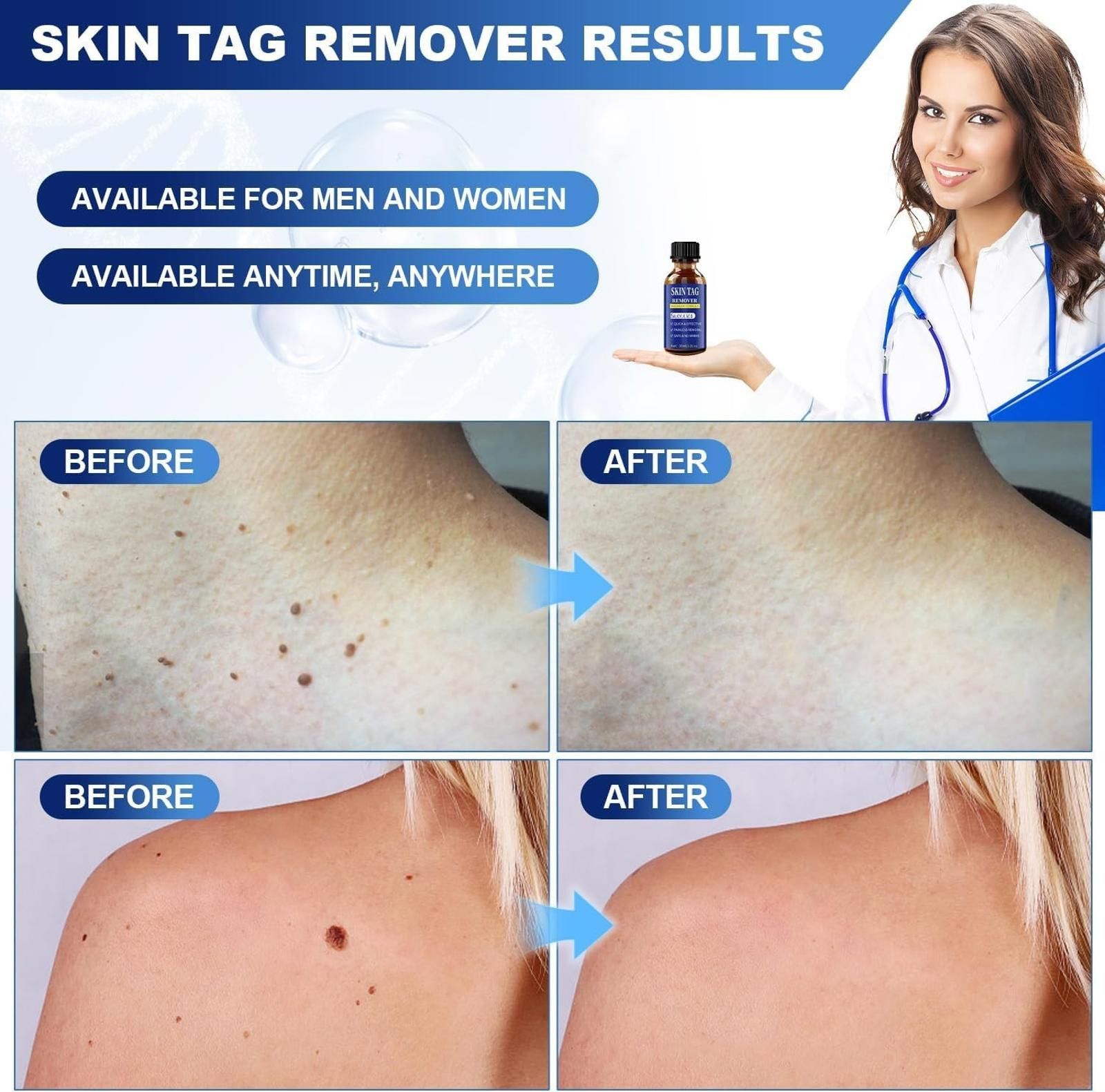 Other Fast-Acting Skin Tag Remover, Maximum Formula 30ml Size ONE SIZE - 2 Thumbnail