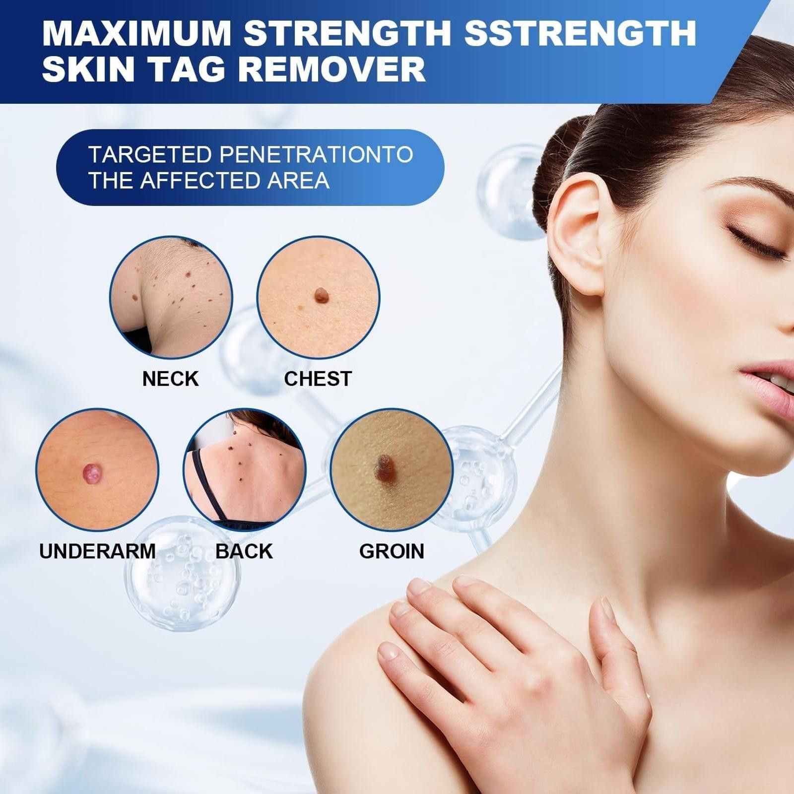 Other Fast-Acting Skin Tag Remover, Maximum Formula 30ml Size ONE SIZE - 3 Thumbnail